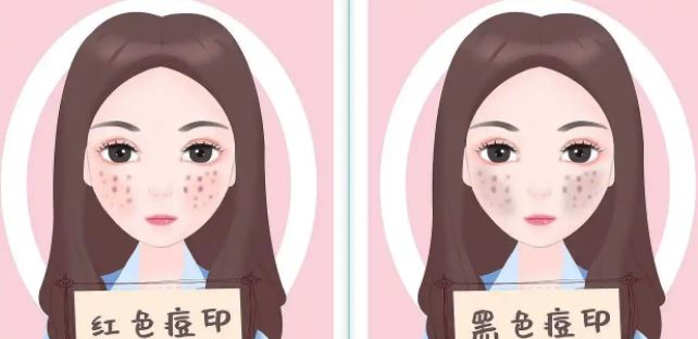 臉上紅色痘印幾個月都不消怎么辦？紅色痘印應(yīng)該怎么消除？