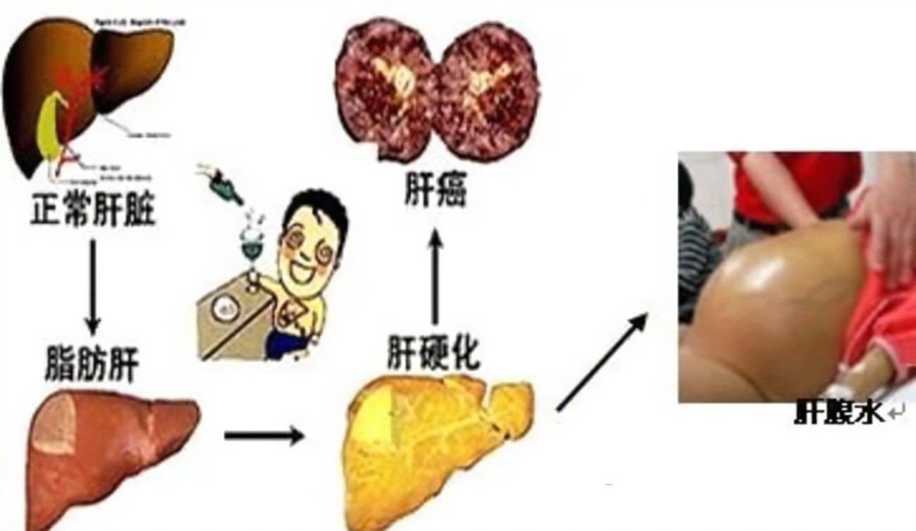 查出肝硬化還有救嗎？