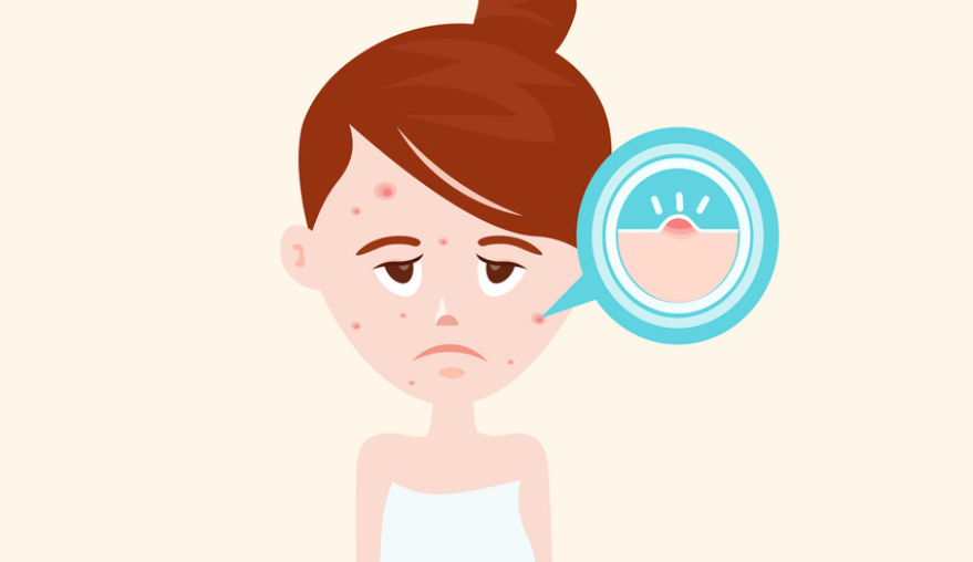青春痘有救了嗎？聽(tīng)說(shuō)青春痘也有疫苗了？