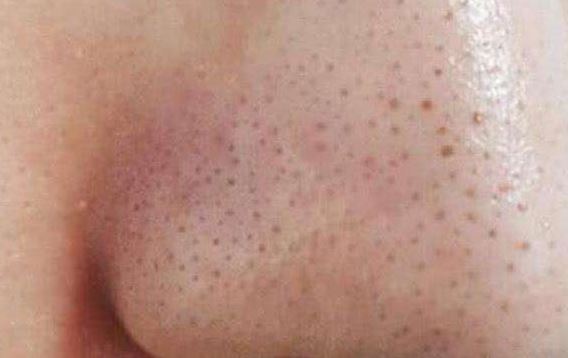 清潔面膜哪個牌子可以快速祛黑頭？趙薇、薇婭 推薦的紐西之謎泥膜真的好用嗎？